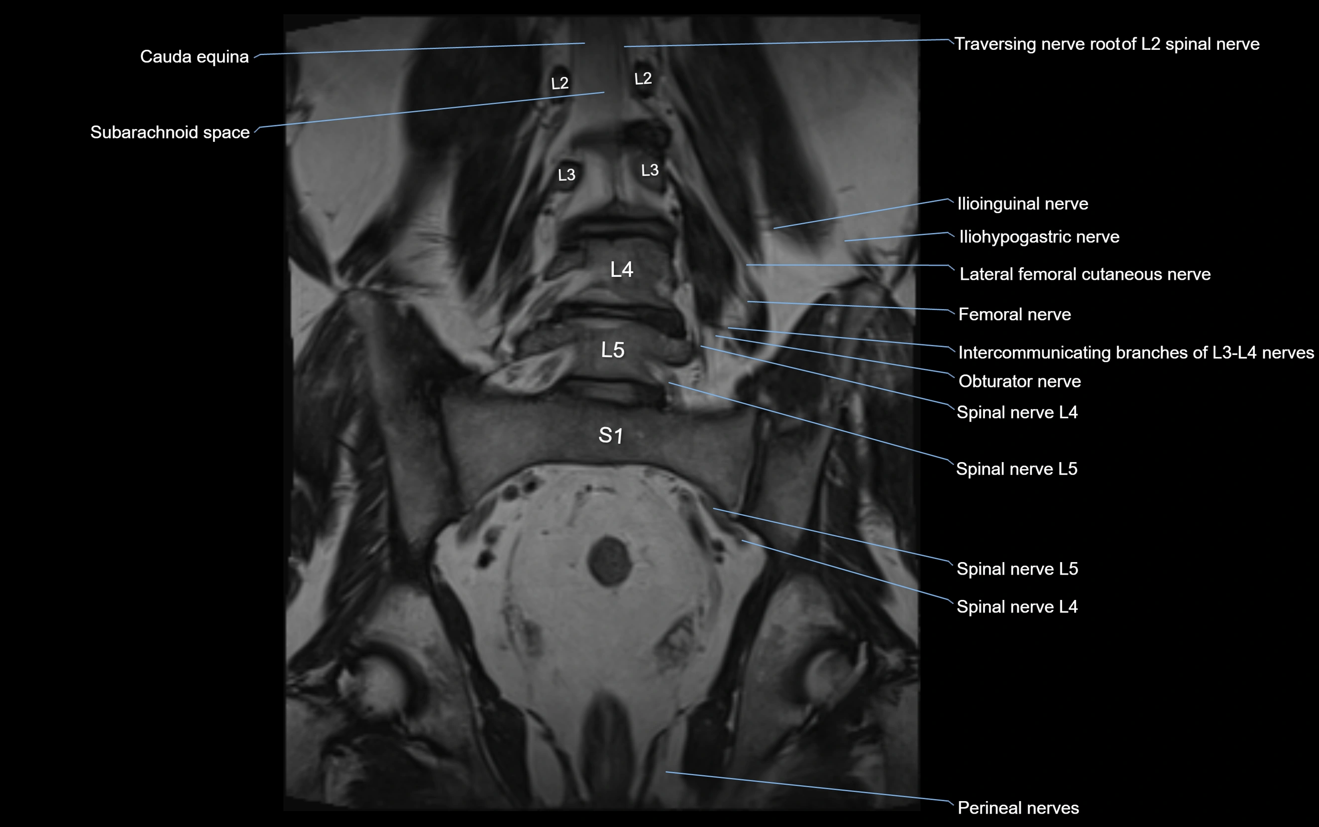 MR lumbosacral plexus cross sectional anatomy 3T  radiology  image-img-09001-00037.webp